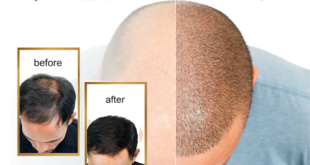Điêu Khắc Tóc Hói Tại Vian Beauty: Đâu Là Điểm Mạnh, Điểm Yếu? 9