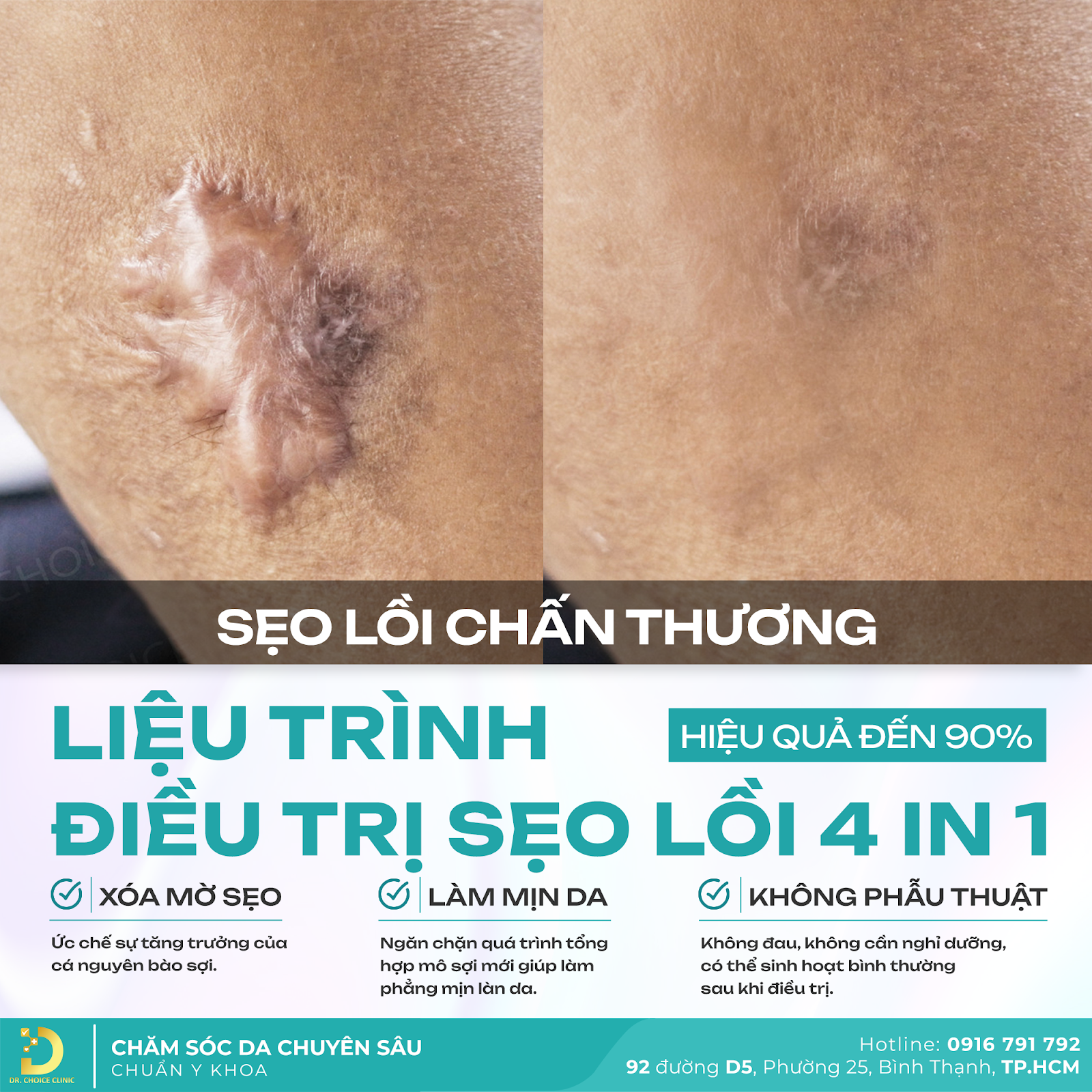 Điều Trị Sẹo Lồi Tại Dr. Choice Clinic Có Đảm Bảo Không? 2